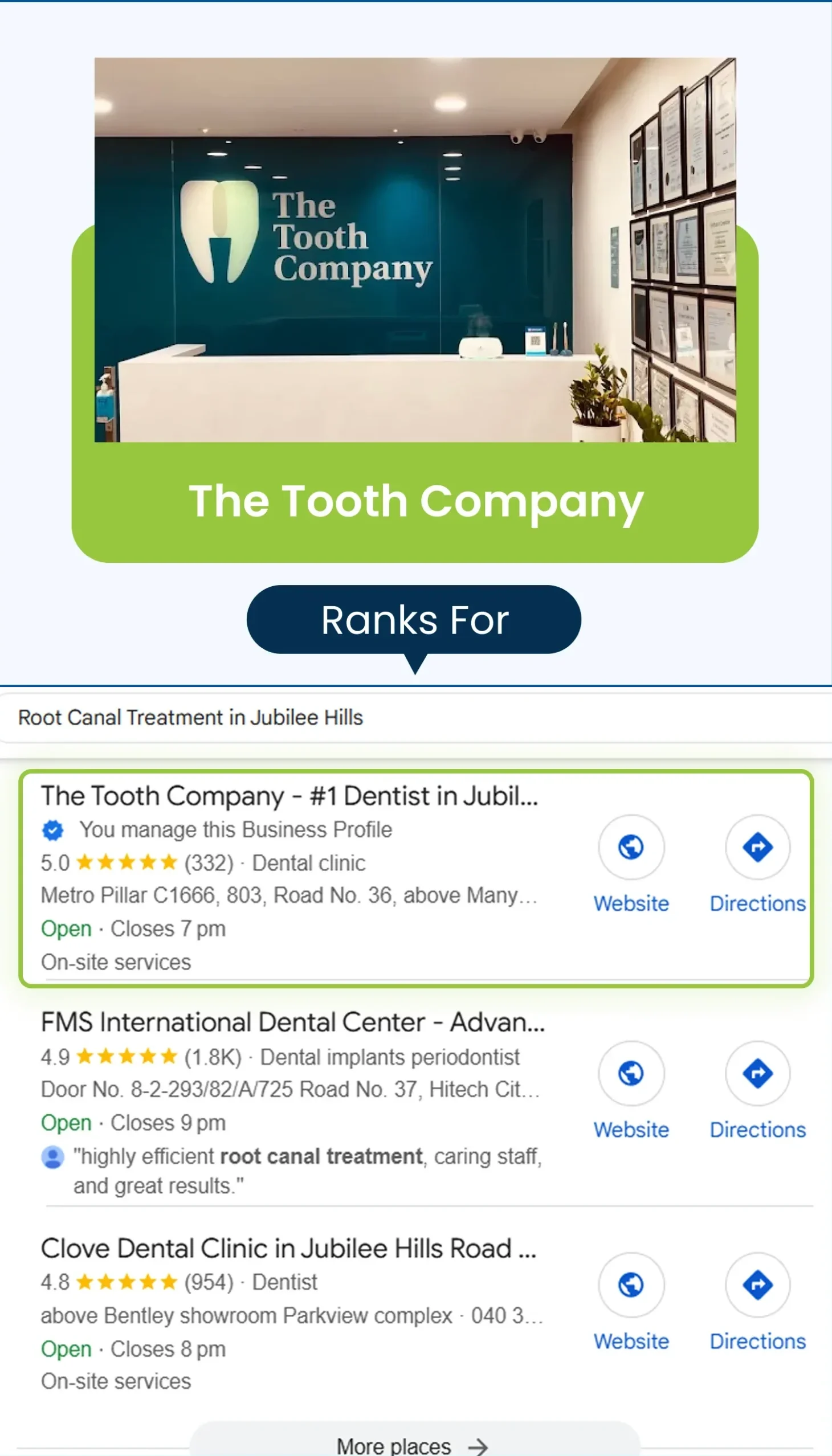 root canal treatment jubilee hills the tooth company 1 e1754485448107
