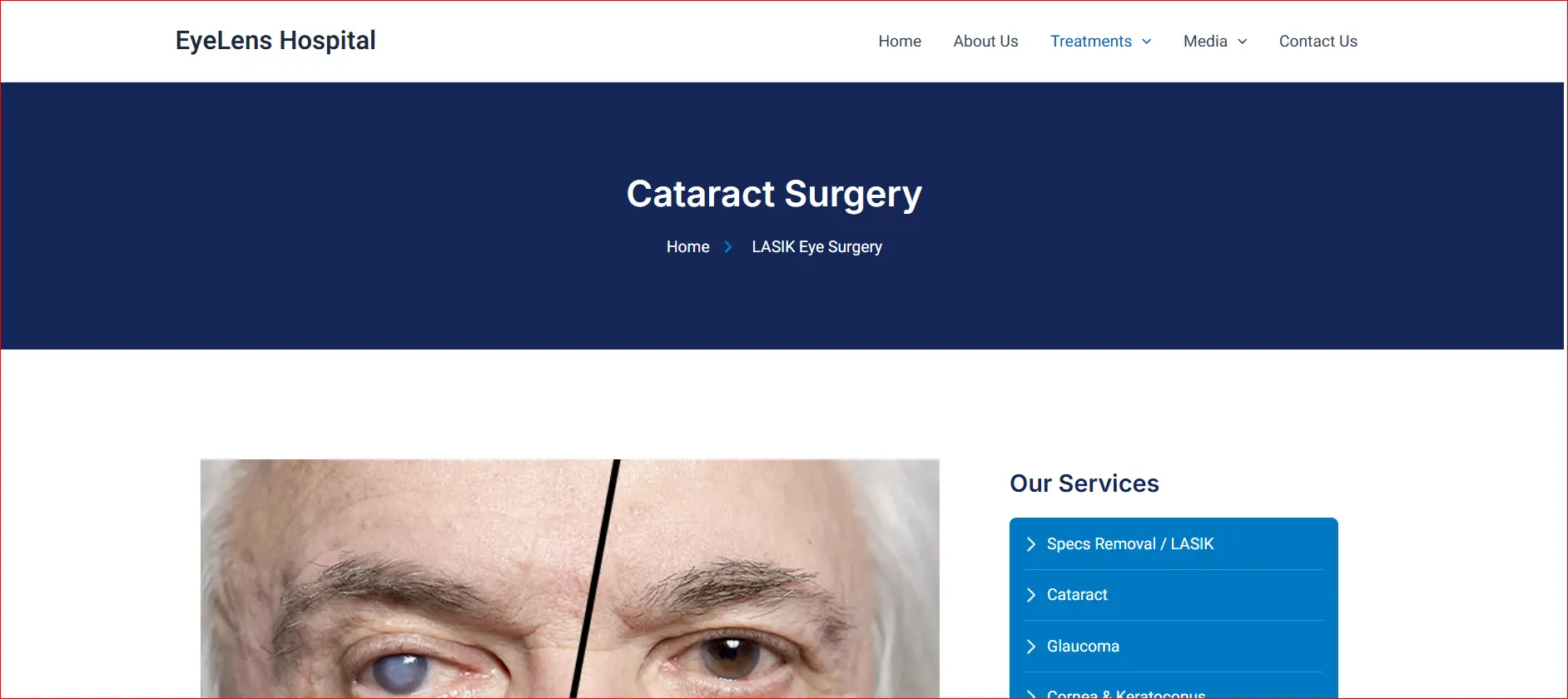 Cataract surgery treatment page at EyeLens Hospital explaining advanced cataract diagnosis and surgical care