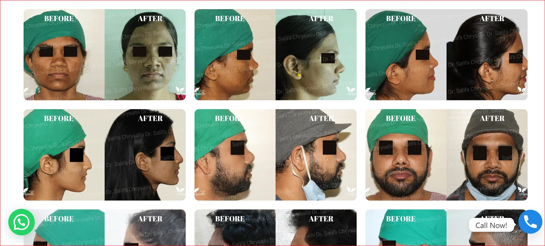 Rhinoplasty Results Gallery